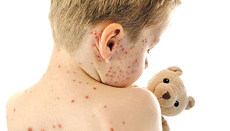 Νέα εγκύκλιος του Υπουργείου για την Ιλαρά