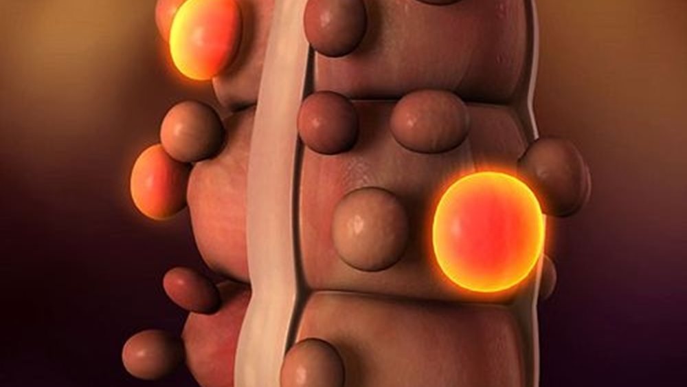 Γιατί “θερίζει” ο καρκίνος του παχέως εντέρου